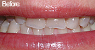 Before Teeth