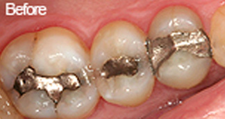 Before Teeth